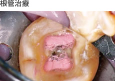 根管治療