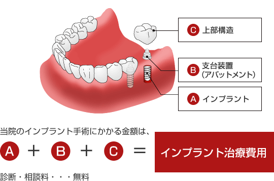 インプラント治療費用