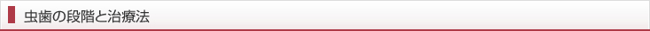 虫歯の段階と治療法