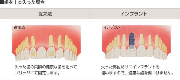 歯を1本失った場合