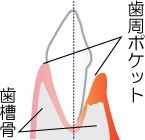 むし歯菌や歯周病菌の殺菌