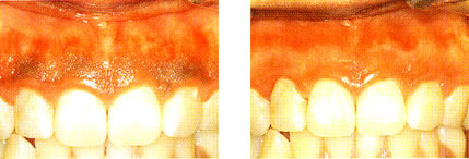 歯ぐきの黒ずみ除去