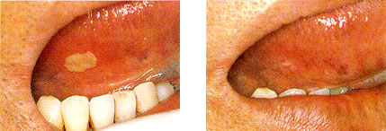 口内炎、知覚過敏の治療