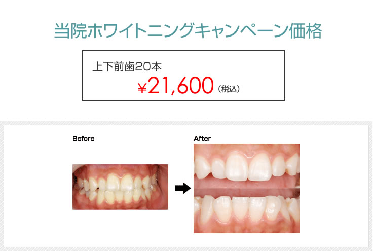 当院ホワイトニングキャンペーン価格