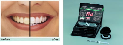 ホームホワイトニング