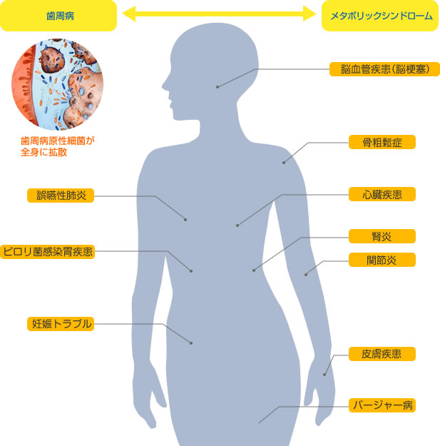 歯周病は全身病である