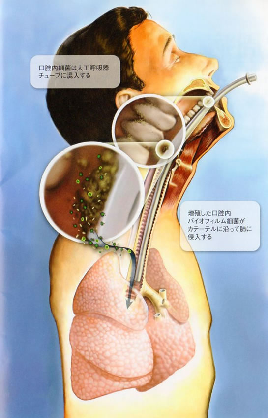 ICU患者の命を狙う歯周病原性バイオフィルム細菌