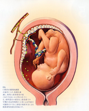 歯周治療がPLBWに与える影響
