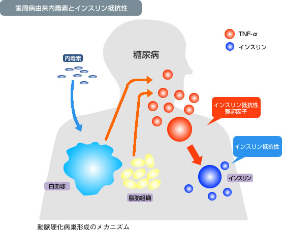 動脈硬化病巣形成のメカニズム