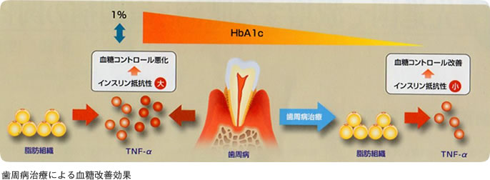 歯周病治療による血糖改善効果