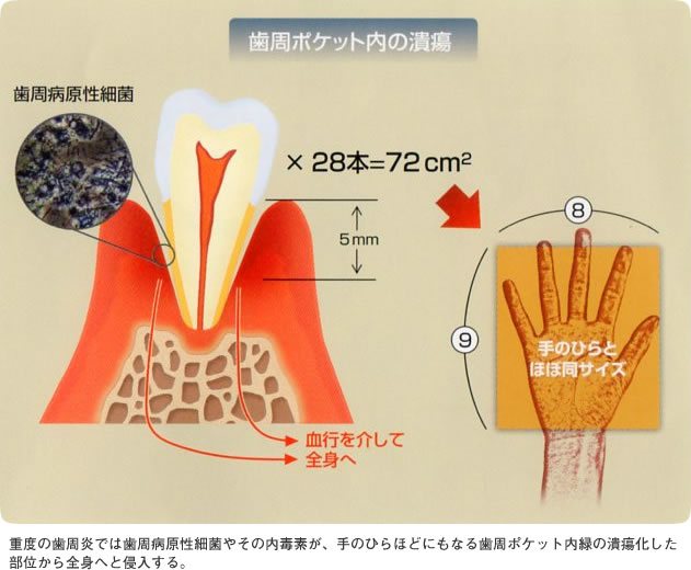 重度の歯周炎では歯周病原性細菌やその内毒素が、手のひらほどにもなる歯周ポケット内緑の潰瘍化した部位から全身へと侵入する。