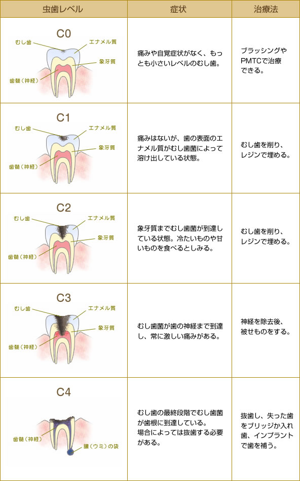 虫歯の進行と段階