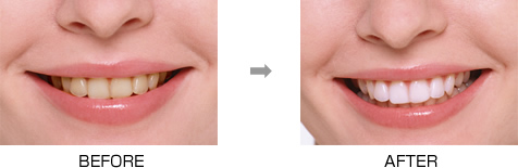 オフィスホワイトニング［ビヨンドシステム］