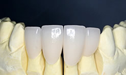 オールセラミック［アルミナ］